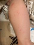 Аллергия или дерматит у ребёнка в два года фото 2