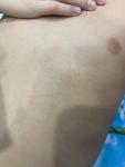Сыпь по всему телу у ребенка, без признаков инфекционного заболевания фото 3