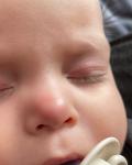 Красный круг на кончике носа у ребёнка! фото 1
