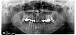 Боль в зубе под коронкой фото 2