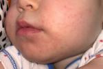 Аллергия или раздражение фото 1