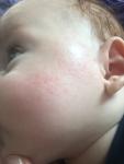 Возрастное или аллергия, сыпь на лице фото 3