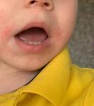 Дерматит на лице у ребенка фото 2