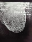 Перелом пяточной кости со смещением отломков фото 2
