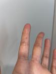 Аллергия на пальцах фото 1