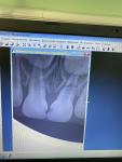 Сломанный корень зуба у ребёнка фото 1