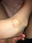 Шишка на голени ноги у ребенка фото 3