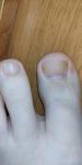 Грибок ногтей рук и ног фото 5