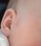 Видоизменяющееся пятно на лице у ребенка фото 1