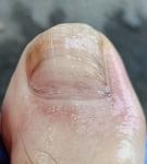 Состояние ногтя на пальце ноги, не грибок? фото 2
