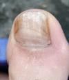 Состояние ногтя на пальце ноги, не грибок? фото 1