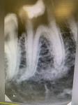 Почему болит зуб после удаления нерва? фото 1
