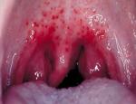 После приема антибиотиков все еще красное горло и увеличились лимфоузлы фото 1