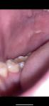 Белые пятна сбоку языка и на щеках. Похоже на лейкоплокию фото 1