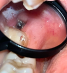 Лунка после удаления зуба мудрости фото 3