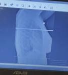 Расшифровка рентгена грудной клетки фото 2