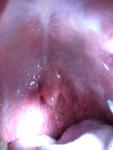 Опухоль в горле фото 2