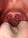 Пупырышки в горле 3 месяца фото 1