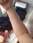 Болячка на руке похожая на укус комара фото 3