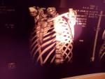 Застарелый перелом грудины с признаками неоартроза фото 5