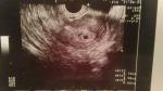 Беременность 5/6 недель, ретрохориальная гематома фото 2