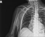 Перелом большого бугорка плечевой кости - боли спустя 4 недели лечения фото 1