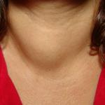 Выпуклость на шее щитовидки фото 1