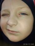 Покраснение и шелушение глаз у ребенка 5 лет фото 1