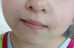 Красная сыпь вокруг рта ребенка фото 2