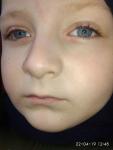Покраснение и шелушение глаз у ребенка 5 лет фото 2