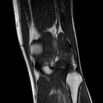 Гиперчуствительность сухожилия ниже колена снаружи фото 5