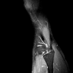 Гиперчуствительность сухожилия ниже колена снаружи фото 2