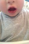Разрыв губы рта у ребенка фото 1