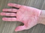 Постоянные боли в пальцах рук (кончики пальцев) фото 1