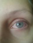 Воспаление глаза с болевым синдромом фото 1