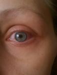 Воспаление глаза с болевым синдромом фото 2