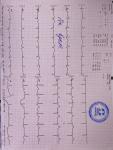 Помогите, пожалуйста, расшифровать кардиограмму (ЭКГ) фото 2
