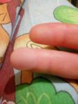 Волдыри на пальцах рук похожие на мозоли фото 1
