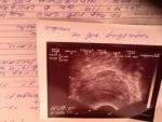 Внематочная, замершая беременность или же эндометриоз фото 2