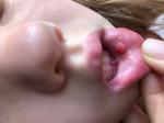 Шишка на губе у ребёнка фото 1