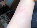 Аллергия по всему телу фото 1