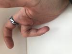 Замена сустава фаланги среднего пальца правой руки фото 3