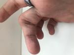 Замена сустава фаланги среднего пальца правой руки фото 4