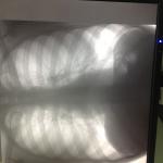 Белые пятна на флюорографии фото 1