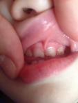 У полуторагодовалого ребенка проблемы с передними зубками фото 1