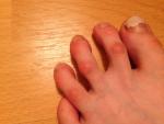 Деформация пальцев на ногах фото 1