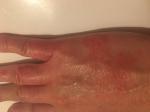 Аллергия на руках, кожа рук трескается и сохнет фото 1