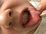 Потертость внутри губы и мелкие прыщечки фото 1