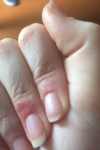 Красное пятно на пальце руки(возле кутикулы) фото 1