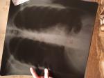 Рентгенография легких, пневмония фото 1
